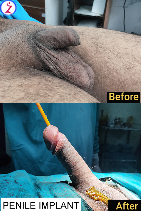 Penis Implant Surgery in Indore - increase penis thickness and length in Indore, Cost Price in Indore, Bhopal, Before After Photos, Results.